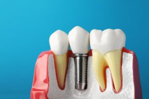 Revolutionary Techniques in Dental Implant Surgery