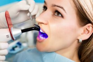 Common Myths About Composite Bonding That Prevent Patients from Seeking Treatment